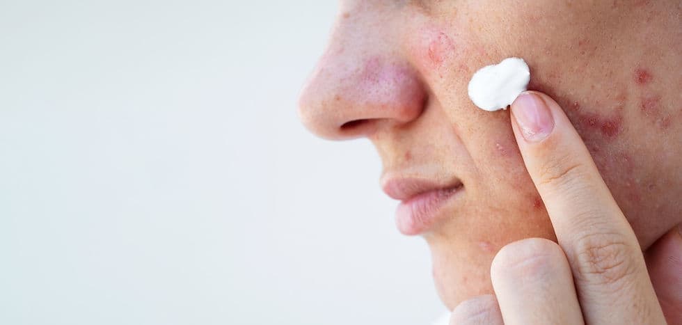 Pair Acne Cream: The Power Duo for Flawless Skin