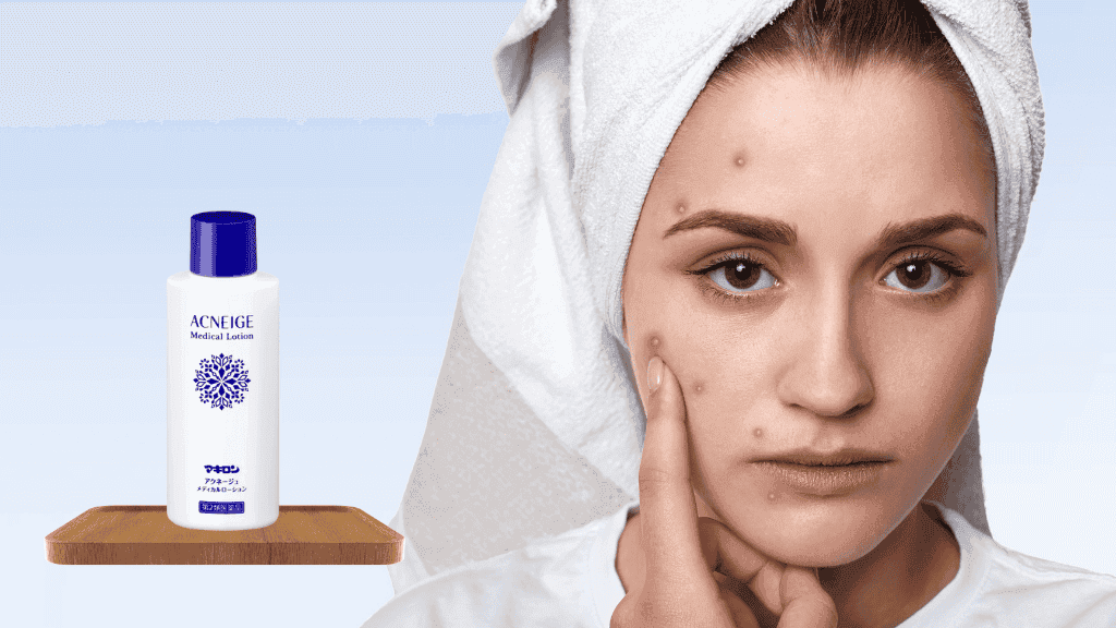 Why Japanese Acne Creams are Taking Over the Beauty World